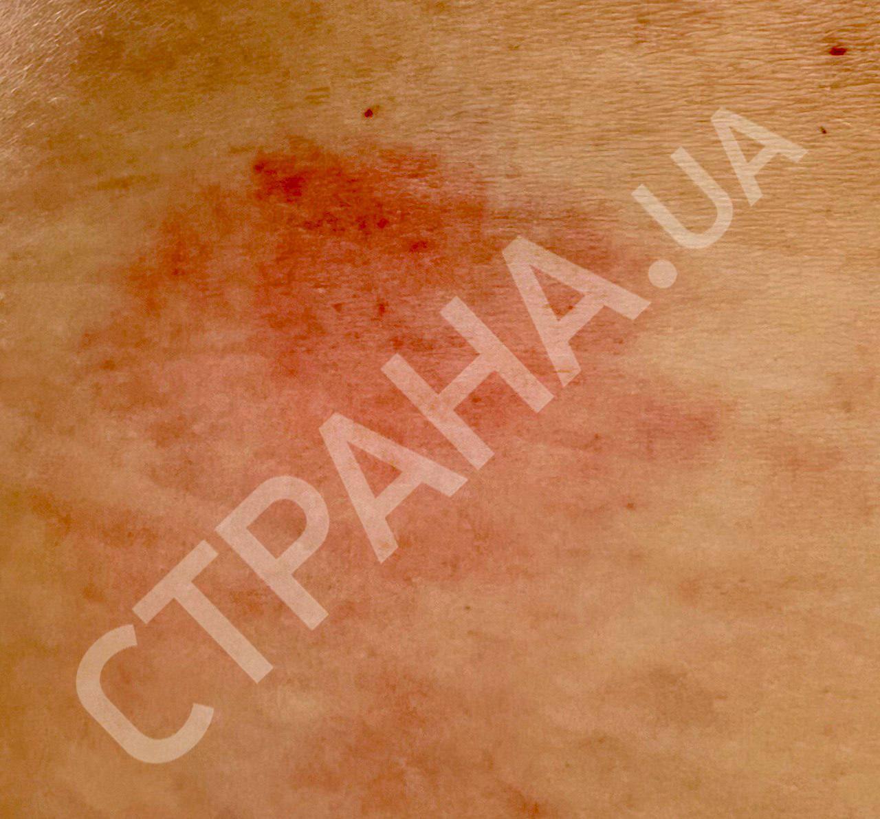 Фото кровоподтёка, причинённого джакузи. Источник - "Страна"